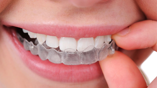¿Qué es la ortodoncia invisible?