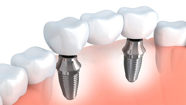 Los implantes dentales son cada vez más demandados por los pacientes