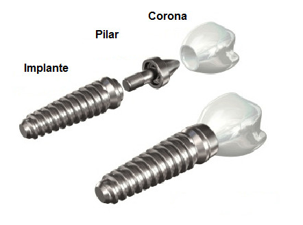 Piezas utilizadas en un tratamiento de implantes dentales