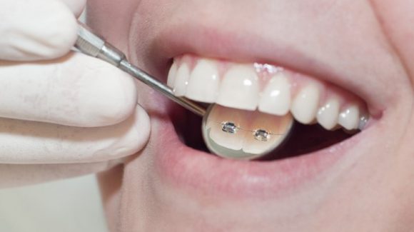¿Qué beneficios aporta la ortodoncia lingual?