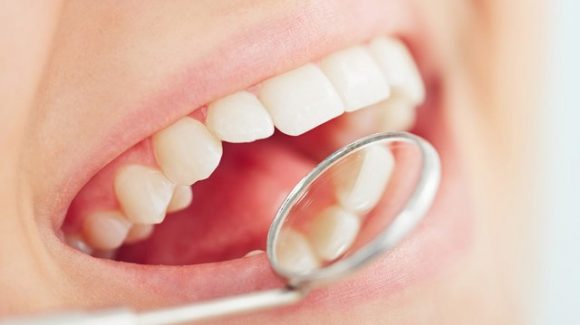 Relación entre periodontitis y la colocación de implantes dentales