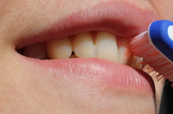Gingivitis. Clínica Dental Pilar Garrido