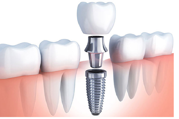 Implantes dentales con carga inmediata