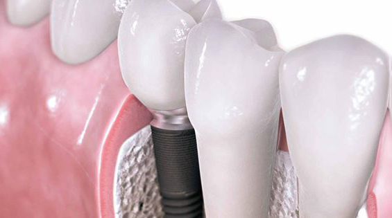 Implantes dentales: beneficios y ventajas