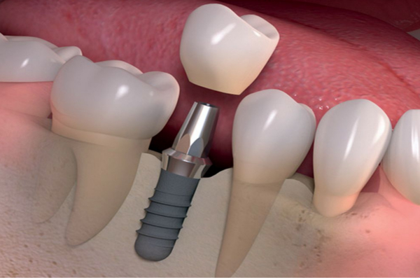 Los tipos de implantes dentales y materiales usados