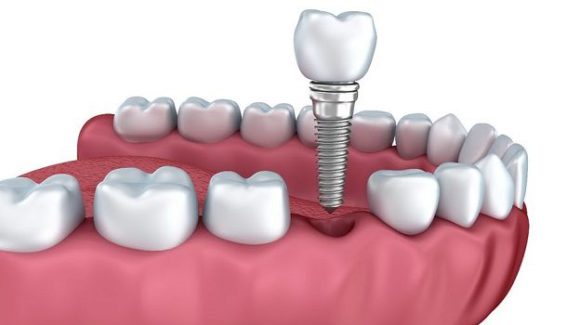 ¿Duelen los implantes dentales?