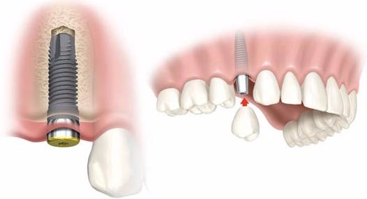 ¿Qué problemas puede causar un implante dental?