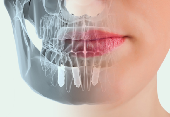 ¿Cuáles son los beneficios más destacados de los implantes dentales?
