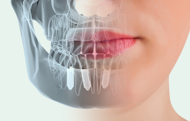 ¿Cuáles son los beneficios más destacados de los implantes dentales?