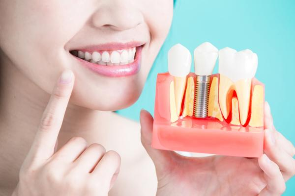 Desmontamos 10 mitos sobre los implantes dentales