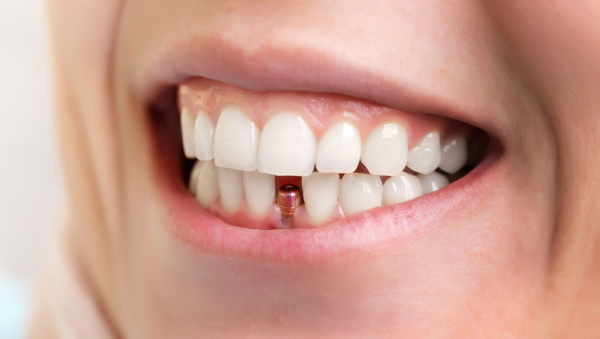 Todo lo que tienes que saber antes de realizarte un implante dental