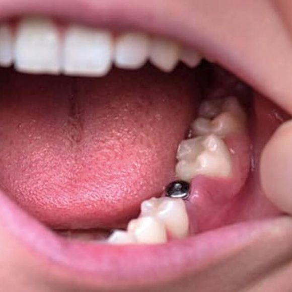 ¿Por qué se produce el rechazo a un implante dental?