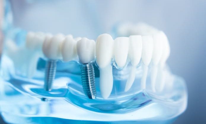 El futuro de los implantes dentales para 2023