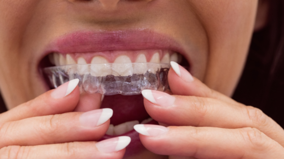 ¿Es posible llevar ortodoncia invisible e implantes dentales?