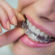 Riesgos de la ortodoncia invisible adquirida por internet