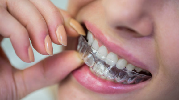 Riesgos de la ortodoncia invisible adquirida por internet