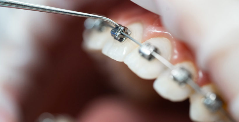 ¿Por qué los brackets pueden rozar más al principio del tratamiento?